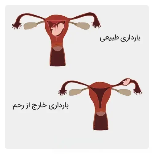 بارداری-خارج-از-رحم