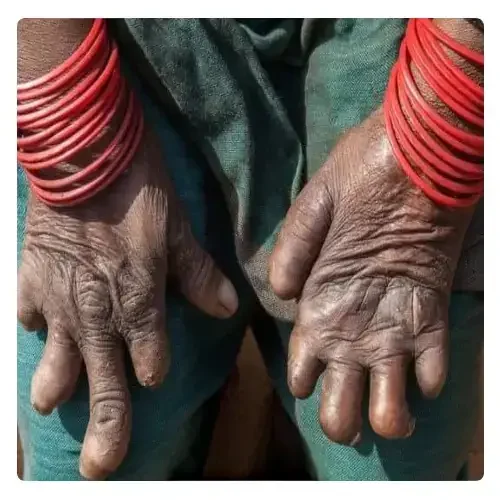 جذام