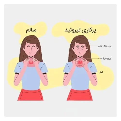 علائم-پرکاری-تیروئید