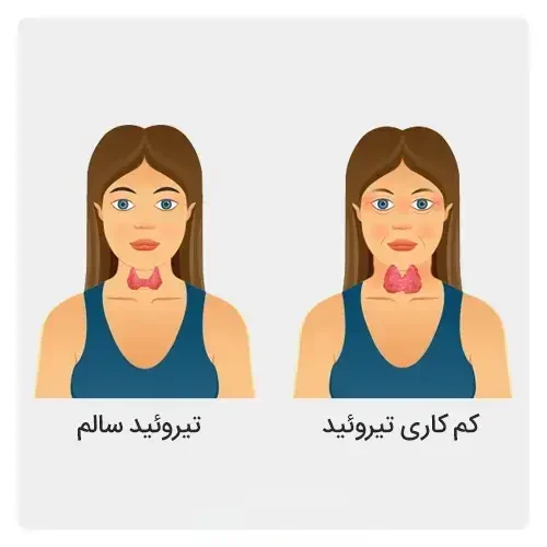 علائم-کم-کاری-تیروئید