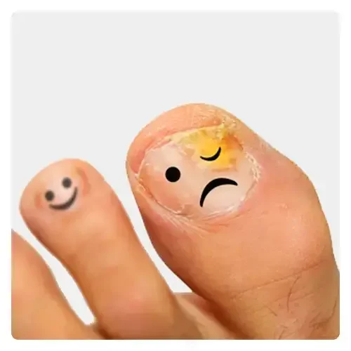 قارچ-ناخن